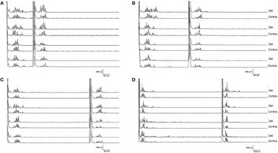 Adult-Onset Gilles de la Tourette Syndrome: Psychogenic or Organic? The Challenge of Abnormal Neurophysiological Findings